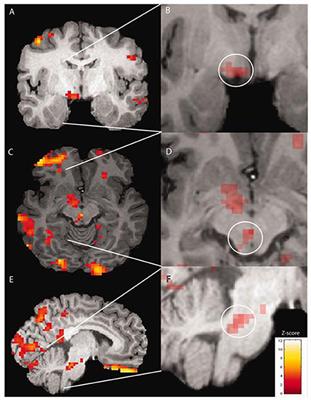 Imaging the Premonitory Phase of Migraine